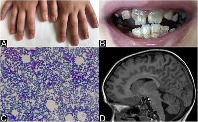 Pure Red Cell Aplasia (PRCA) and Cerebellar Hypoplasia as Atypical Features of Polyglandular Autoimmune Syndrome Type I (APS-1): Two Sisters With the Same AIRE Mutation but Different Phenotypes